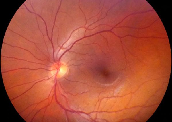Cámara Retinal Midriática Portátil Volk VistaView - Image 4